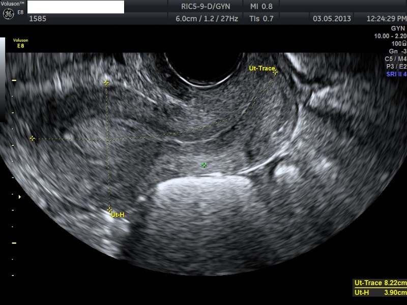 Pelvic Ultrasound - POGU