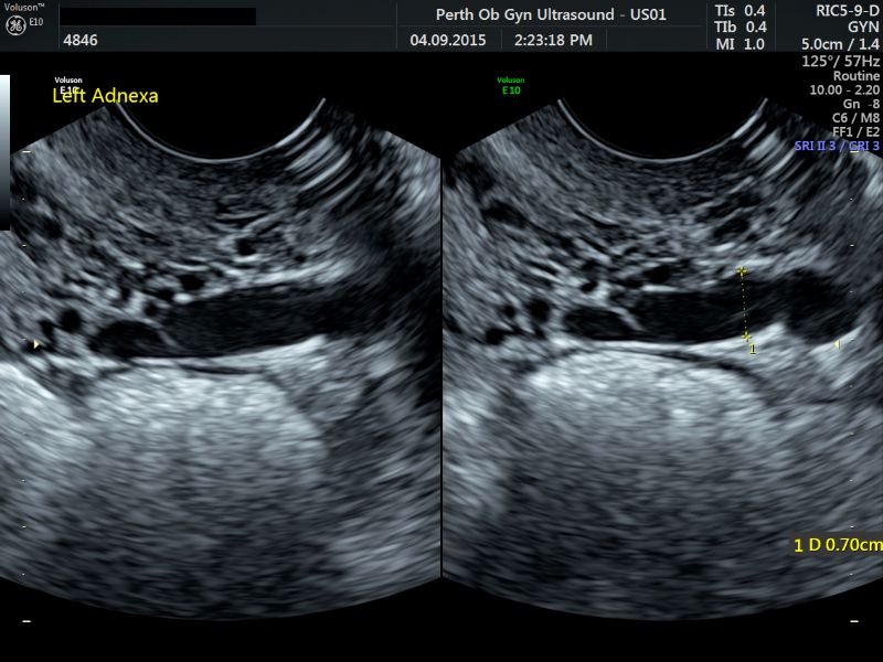 Pelvic Ultrasound - POGU