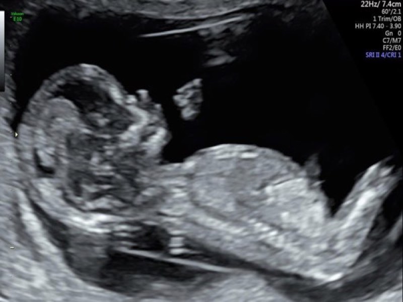 Appointment? at ultrasound happens your what 12-week What is