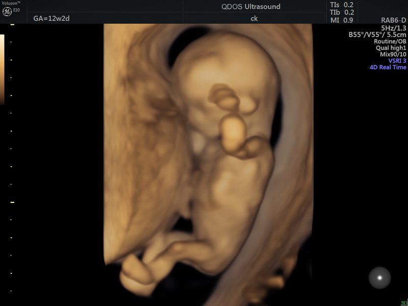 Baby Ultrasound At 12 Weeks
